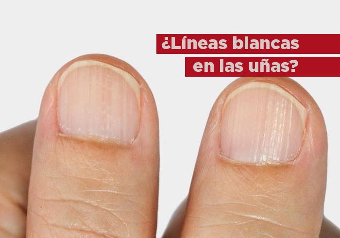 ¿Líneas blancas en las uñas? Esta es la vitamina de la que tienes deficiencia